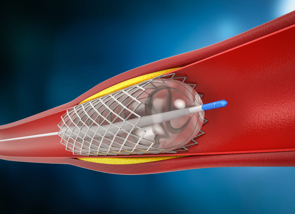 Angioplastia coronaria en Puebla